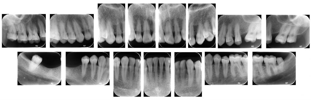 Radiografía Periapical Total – Ray Dent