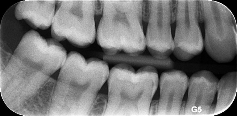 Radiografía Bite Wing – Ray Dent